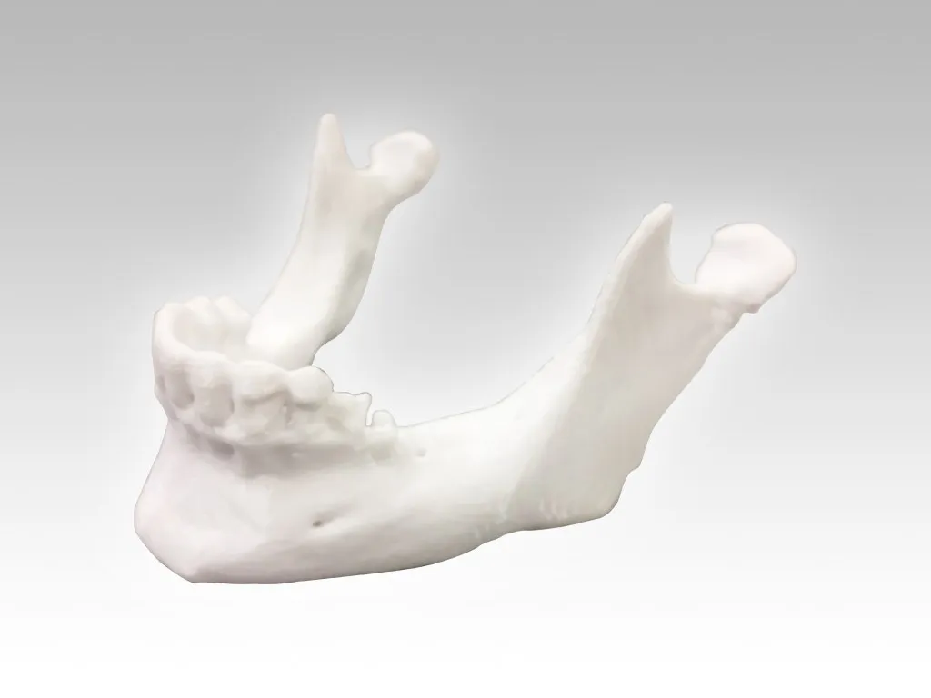 White APD-printed jaw model after its supports were removed